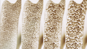 stages of osteoporosis